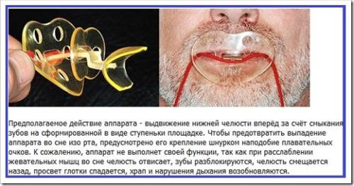 Соска от храпа
